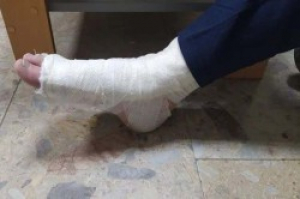 У Тернополі чоловік, викрадаючи велосипед, зламав ногу