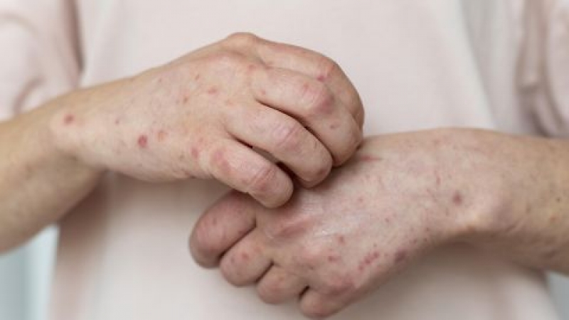 За вісім місяців в Україні на кір захворіло учетверо більше людей, ніж за весь минулий рік